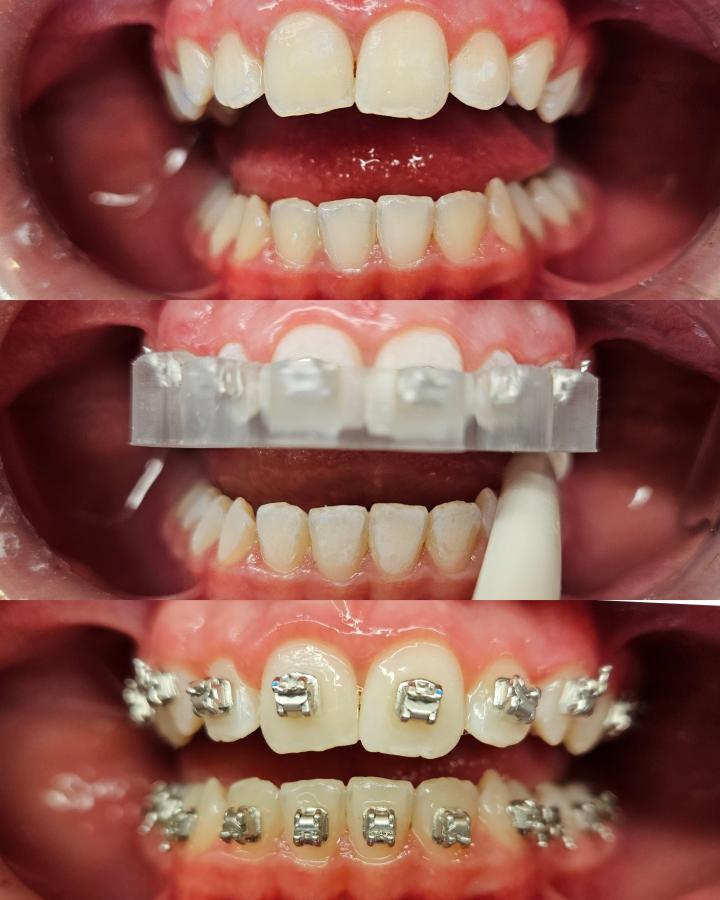 Nosiče na nepřímé lepení fixního aparátu